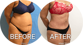 before after photos tummy tuck