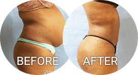before after photos liposuction