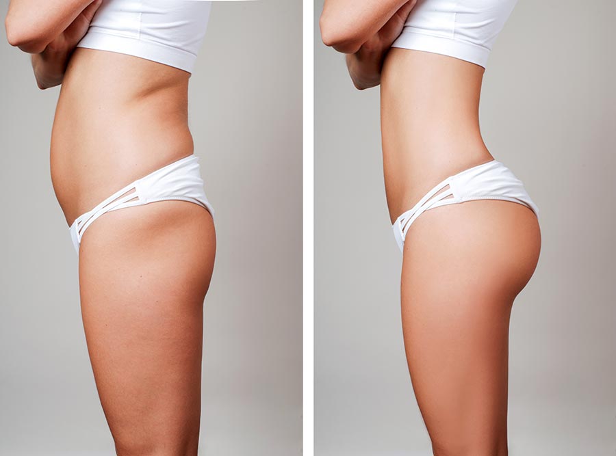 Affordable Liposuction Near Me? It's Possible! - Mid-Atlantic Skin
